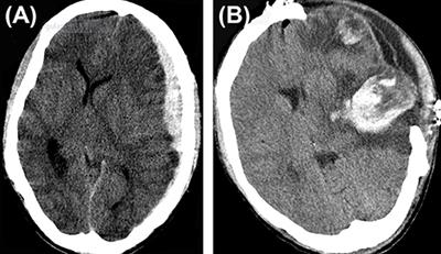 Complications of Decompressive Craniectomy